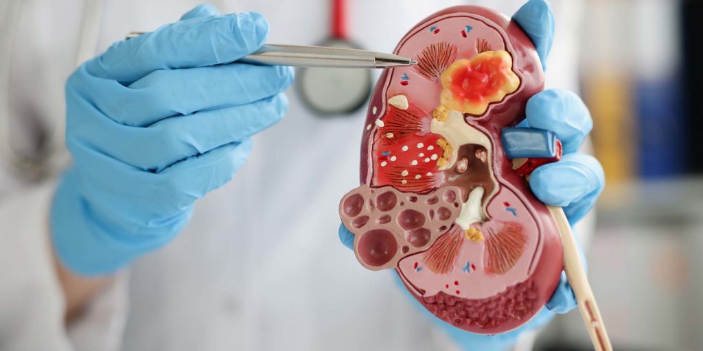 a-quick-guide-to-immunoglobulin-a-nephropathy-igan-sharecare