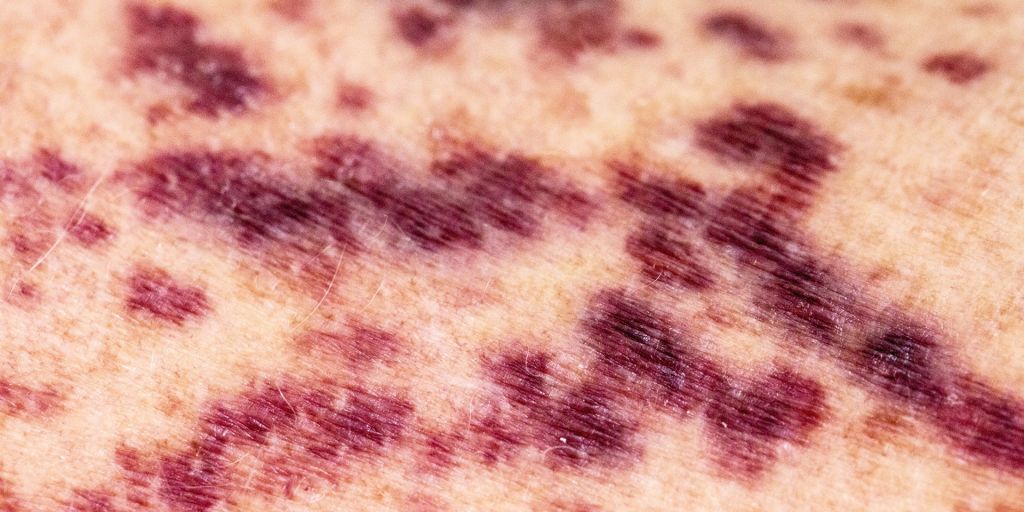 Why ITP Causes Bleeding and Bruising Symptoms Sharecare