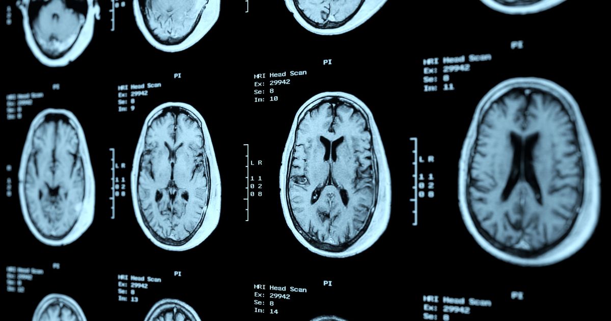 CTE Causes, Risk Factors, and Prevention Sharecare