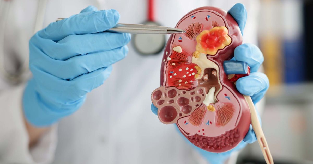 A Quick Guide to Immunoglobulin A Nephropathy (IgAN) Sharecare