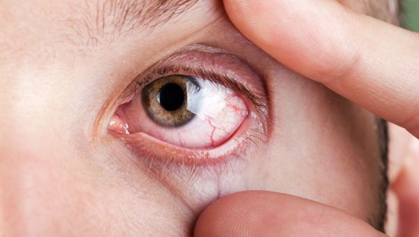 eyes, red eye, eye infection, eye irritation
