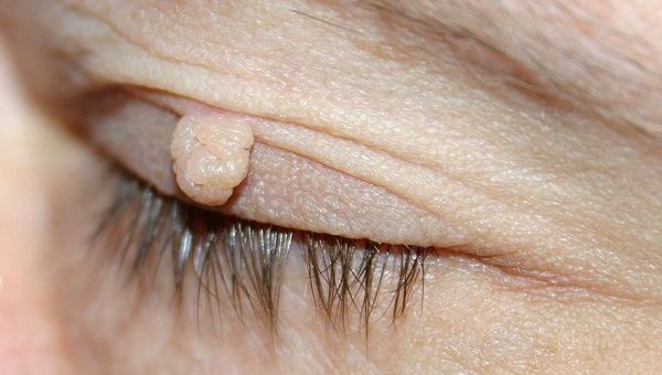 Large skin tag on the upper eyelid of a person with light skin