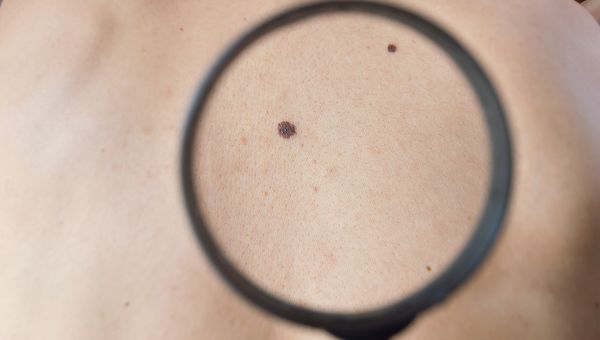 Two small, dark moles on a person with light skin being inspected by a magnifying glass