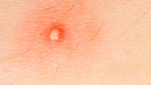 Whats On My Skin 8 Common Bumps Lumps And Growths Skin Health