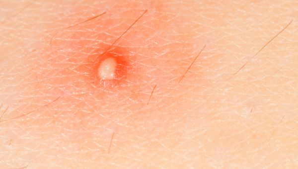 Small inflamed boil on a person with light skin