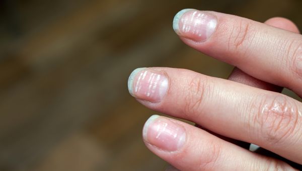 brittle spotted nails caused by anemia