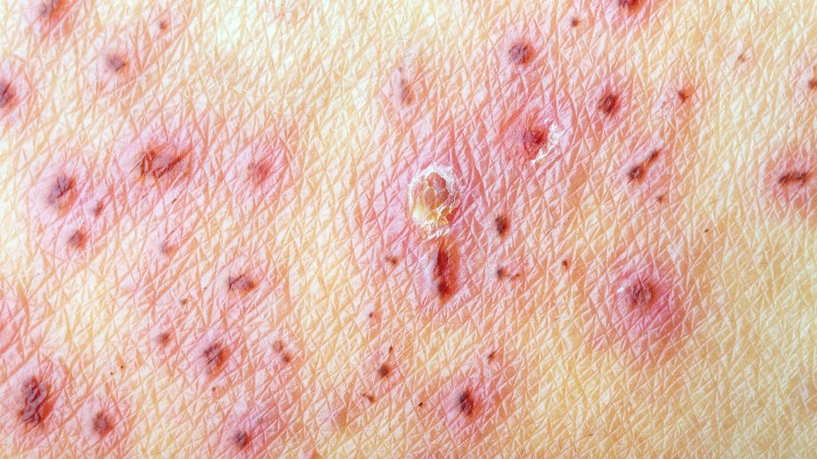 skin lesions