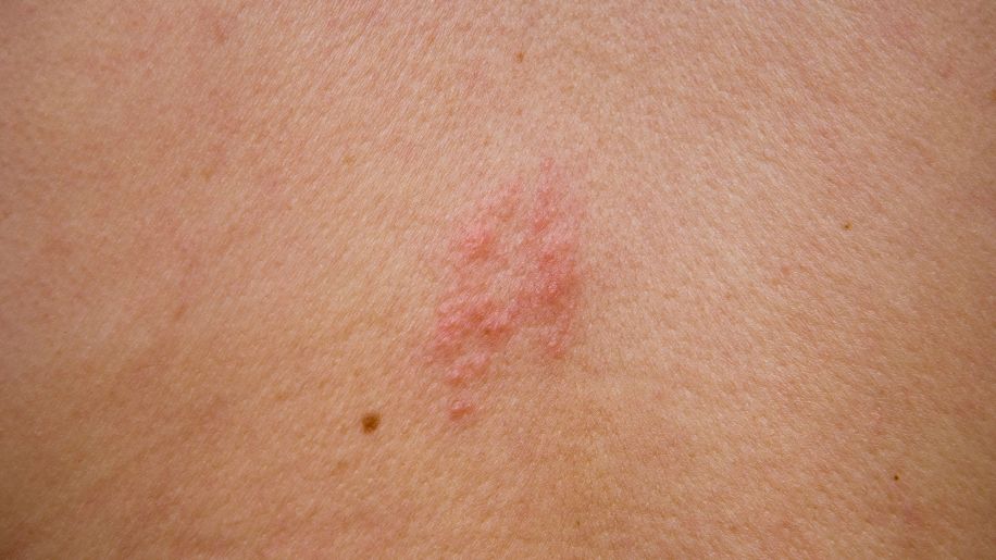 shingles, shingles rash, hives, rash, skin rash
