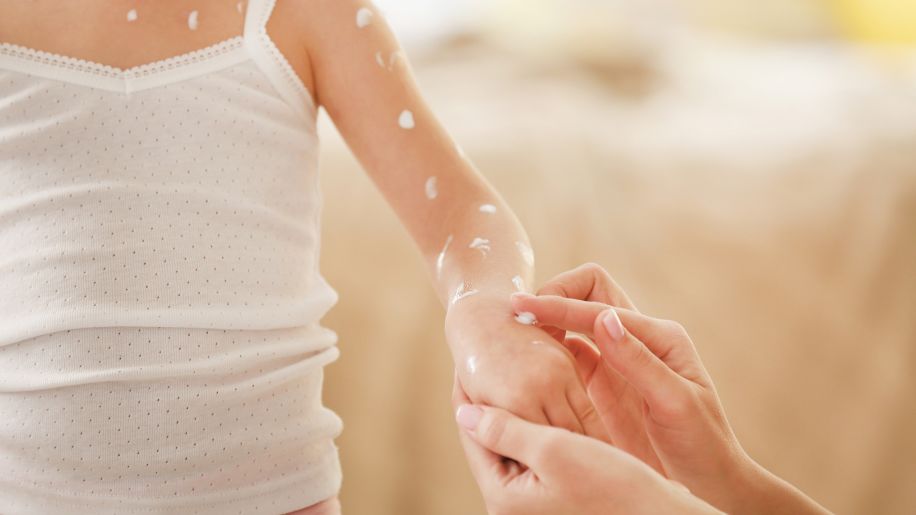 a mother putting ointment on their child's chickenpox