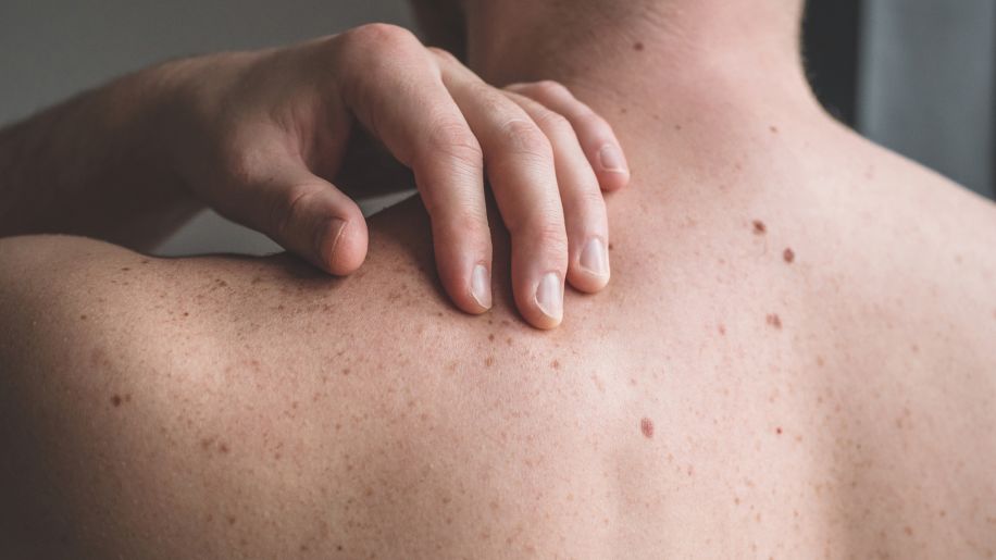 Freckled skin on a man's back. 