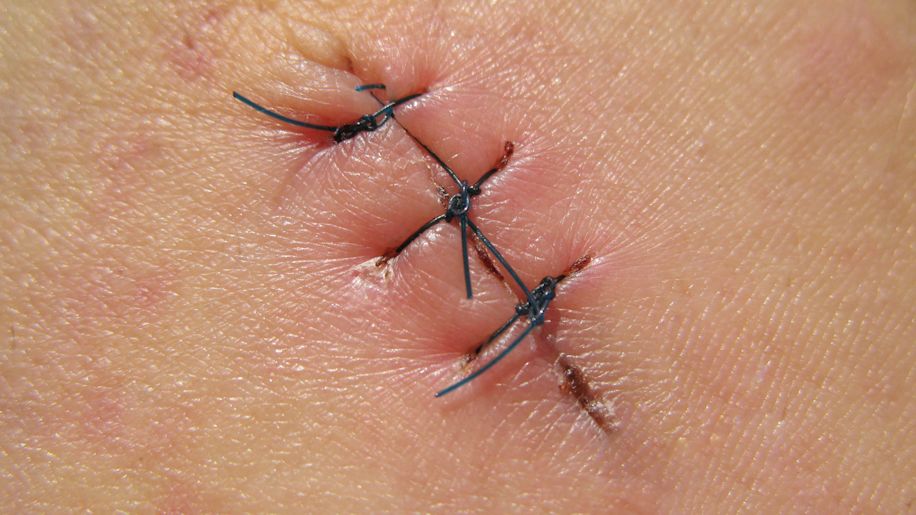 Closeup of stitches on skin.