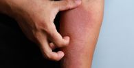 Understanding and Managing Atopic Dermatitis