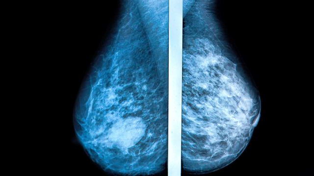 mammogram x ray