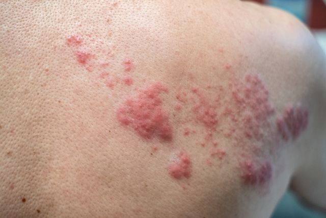 What You Need To Know About Shingles