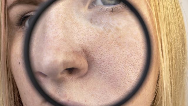A dermatologist examines a dark spot near a patient's nose.