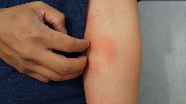 Atopic Dermatitis on a man's arm.