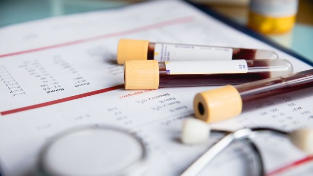 Blood samples in vials in a doctor office. Complete blood cell counts are important to diagnosing and monitoring CML.