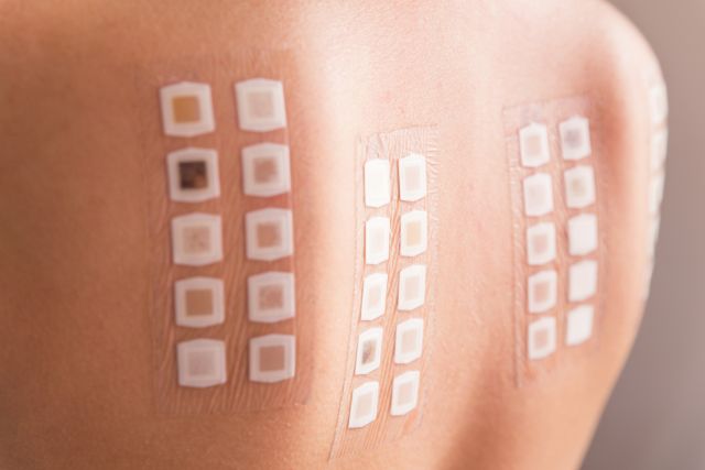 closeup of allergy patch test taped to a woman's back