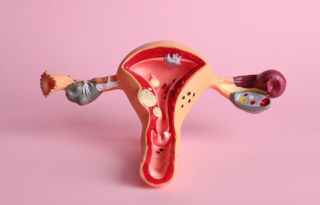 While the exact cause of endometrial cancer is not known, hormonal imbalances are known to play an important role in its development.
