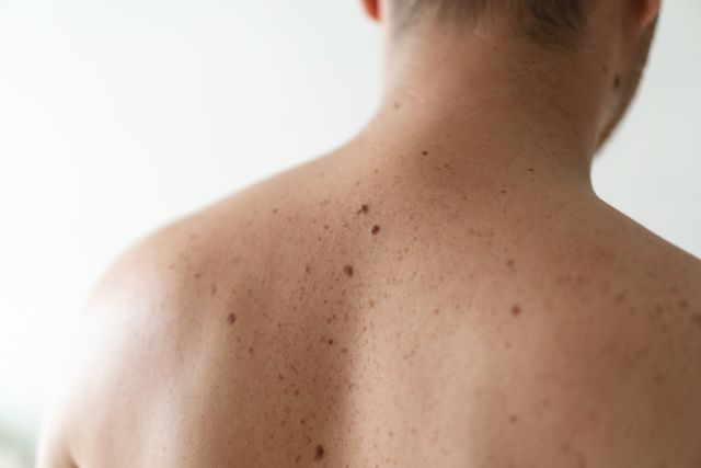 View of a man's bare back with lots of freckles and some moles
