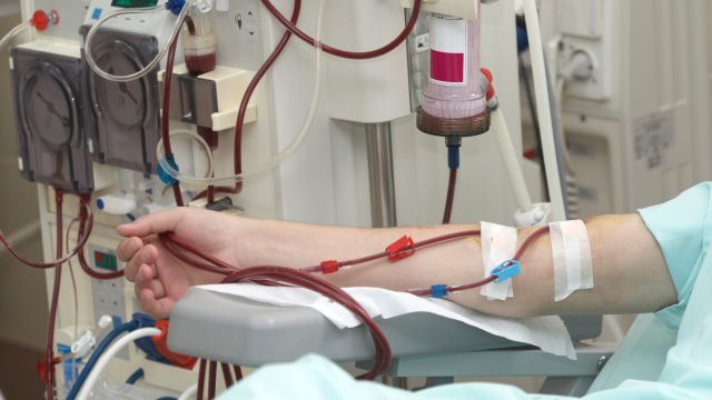 A person with chronic kidney disease (CKD) is treated with hemodialysis. CKD is a potential complication of IgA nephropathy.
