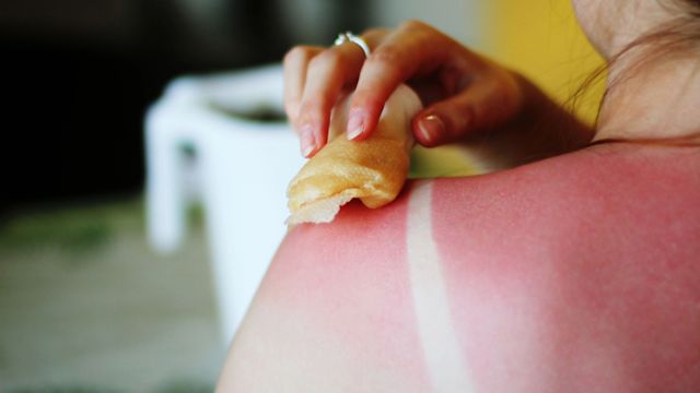 A woman applies a cool compress to a sunburn on her back and shoulders. Sunburn and other injuries to the skin have been associated with the onset of psoriasis.