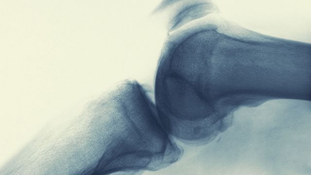 X-Ray of an arthritic knee.