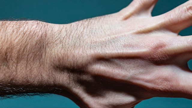 View of a cyst on man's stretched out hand.