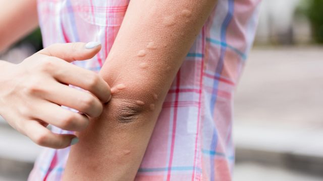 woman with hives on arms