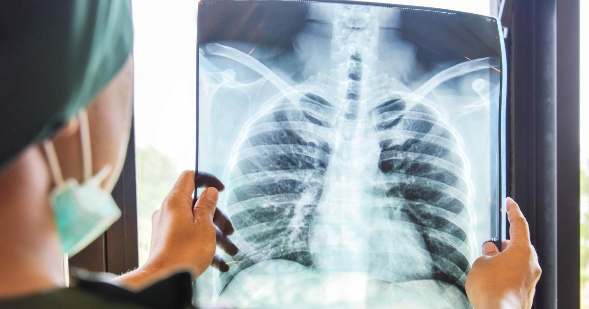 Ending The Global Tuberculosis Epidemic Pursuit By The University Of Ending The Global Tuberculosis Epidemic Pursuit By The University Of