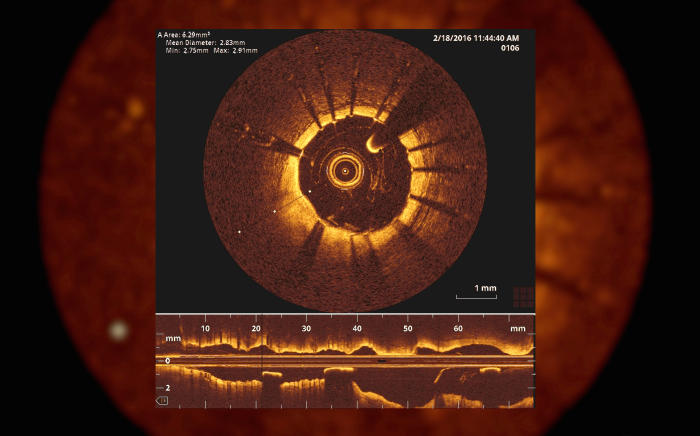 A still image of the interior of one of the patient’s arteries, captured using tiny optical coherence tomography (OCT) during surgery at St Vincent’s Hospital, Melbourne. Picture: Paul Burston