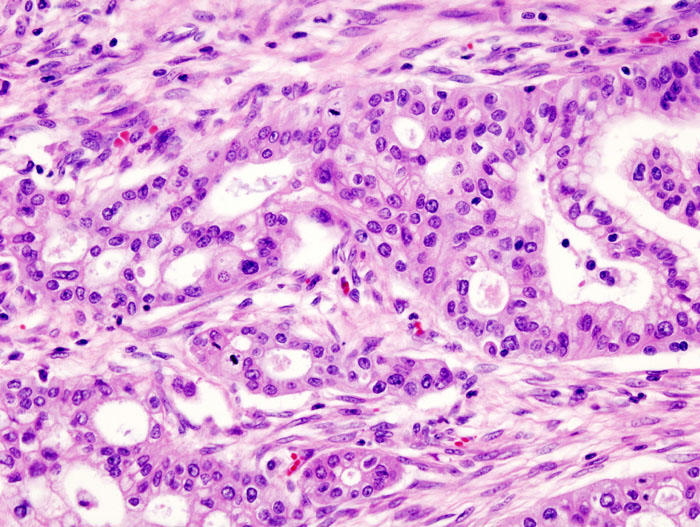 Micrograph of pancreatic ductal adenocarcinoma, the most common type of pancreatic cancer. Picture: KGH/Wikipedia